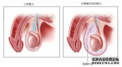 腹腔镜术 轻松解决鞘膜积液