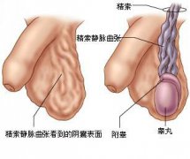 精索静脉曲张的危害都有哪些