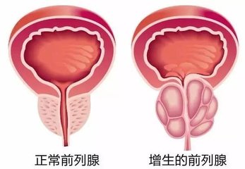 男士遇到前列腺增生的原因